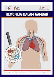 Hemofilia dalam Gambar (terjemahan dari Hemophilia in Pictures)